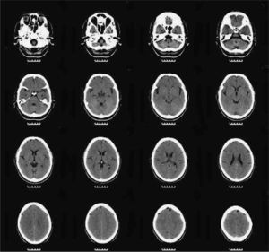 Magnetic resonance image in which the presence of slight, predominantly frontal cerebral atrophy is notable.