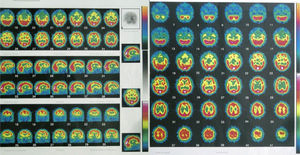 SPECT image showing a bilateral temporal hypoperfusion.