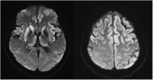 DWI sequences with restriction of the frontal and insular cortex, putamen and caudate (predominantly right asymmetry) and thalamus (mediodorsal nucleus).