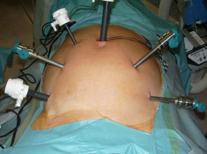 Placement of trocars for robot-assisted surgery.