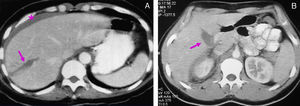Hepatic laceration. Traumatic hepatic lacerations (A) right lobule of the liver and (B) near the hilum. Linear low-density areas in contact with the capsule (arrows). Free fluid (asterisks).