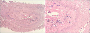 Staining with haematoxylin–eosin. Human saphenous vein occluded by fibrosis (File Dr C. Garcia-Madrid).