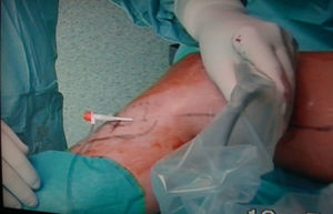 Percutaneous access to the infragenicular saphenous vein for catheter insertion.