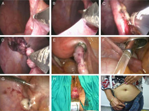 (A) and (B) Release of adhesions; (C) electrocoagulation of the mesoappendix; (D) amputation of the caecal appendix; (E) removal of the organ inside the vaginal trocar cannula; (F)–(G) irrigation and aspiration of the region; (H) colpotomy closure; (I) aesthetic result of the intervention.