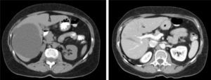 Abdominal CT: laparoscopic pre-fenestration and post-fenestration simple cyst.