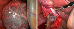 Simple liver cyst undergoing laparoscopic fenestration with Ligasure®.