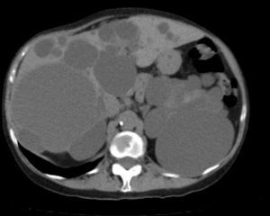 CT: polycystic liver disease.
