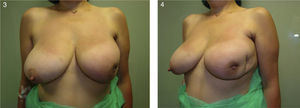 Severe effects from a lateral resection (middle third) Local excision and extension of the margins constitute a high-risk scenario for deformities in segment I, where both deviation of the NAC and the breast contour deformity are seen. This 47-year-old woman had an infiltrating lobular carcinoma and underwent a quadrantectomy with expanded margins and a second procedure was necessary due to inadequate margins. The result was an apparent deformity in the lateral segment of the breast that required a mastectomy and immediate breast reconstruction with expander, given the presence of the disease in the new surgical margins.