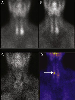 (A) 99mTc-sestamibi, planar scintigraphic image (early phase). (B) Image at late phase. (C) Image after performing pertechnetate subtraction. No images suggesting possible adenoma are observed. (D) Subtraction technique after suppression of the thyroid function. There is an area with marked uptake near the upper pole of the right thyroid lobe (arrow) which was later confirmed as an adenoma.