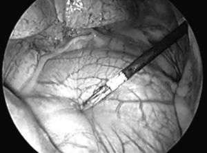Pericardial traction with an endoscopic clamp, following visualisation of the phrenic nerve.