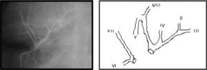 Intraoperative cholangiography during emergency re-operation performed in our unit. Absence of the right posterior biliary radical (a). (b) Biliary tree injury diagram.
