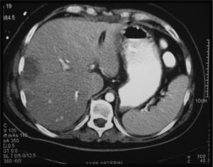CT scan performed after re-operation to suture the ruptured right hepatic artery. Necrosis of the right hepatic lobe.