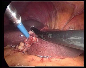 Intraoperative ultrasound.