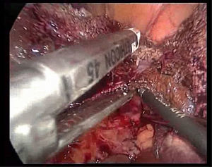 Division of the left suprahepatic vein with an endostapler.
