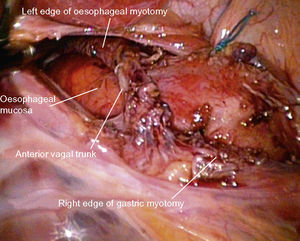Image of the operating field showing the completed myotomy, which has preserved the anterior vagal trunk.