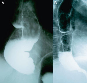 (A) Sigmoid oesophagus with tapering stenosis of the gastro-oesophageal vestibule and food retention in the oesophageal lumen. (B) Two months after the surgical intervention, dilation and tortuosity have decreased and the clinical result is good.