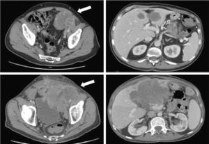 Evolution of the pelvic mass and hepatic metastases despite surgical treatment.