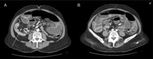 Abdominal CT. (A) Image of a collapsed intestinal loop corresponding to internal hernia and (B) image showing oedematous dilated bowel loops and airfluid levels.