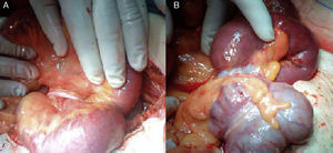 (A) Attachment of the appendix to the mesentery causing a loop in the appendix and (B) when the appendix is resected, the constricting band can be observed.