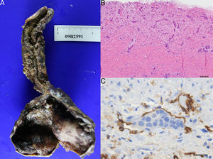 (A) Bile duct cystic wall and atrophic gallbladder. (B) Presence of malignant cell trails infiltrating the cystic wall. (C) Lymphatic permeation of the neoplasia demonstrated by CD-31 marker.