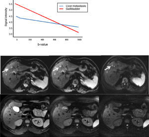 Loss of intensity of a liver metastasis and gallbladder signals upon increasing the b-value. The graph represents this loss of signal intensity. The gallbladder loses a high amount of signal, and the metastasis, little. In the top images, a breast cancer liver metastasis is shown as it loses almost no signal in the diffusion images upon increasing b-values (b=0, b=50, b=600s/mm2). In the bottom images the gallbladder loses much signal in the diffusion images upon increasing the b-values (b=0, b=600, b=1000s/mm2). SI: signal intensity.