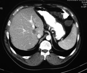 Liver metastasis on CT between the cava, hepatic hilum and suprahepatic veins.