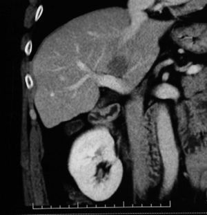CT coronal plane showing liver metastasis adjacent to vascular structures.