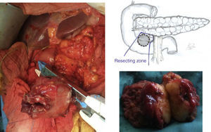 Intraoperative view of the tumor, resection outline and surgical specimen.