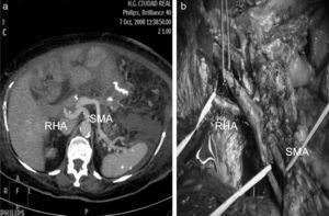 (a) Right hepatic artery originating from the superior mesenteric artery after MIP axial reconstruction; (b) right hepatic artery originating from the superior mesenteric artery.