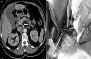 (a) Multi-slice computed tomography showing evidence of common hepatic artery originating from the superior mesenteric artery; (b) intraoperative image of the common hepatic artery originating from the superior mesenteric artery.