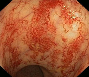 Endoscopic appearance of radiation proctitis with an area of ulceration.