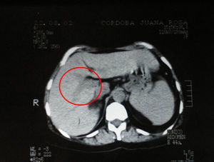 Tomography at the time of the trauma showing the irregular appearance of the right portal vein branch.