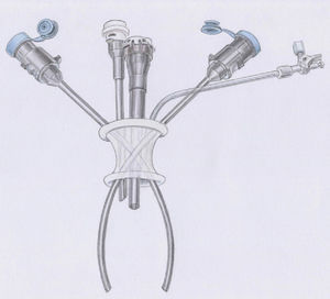 The da Vinci single-access technology for robot-assisted cholecystectomy.