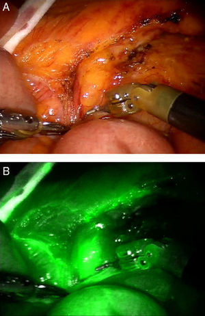 Robotic dissection of a preaortic lymph node during sigmoid resection due to neoplasm: (A) standard endoscopic view; (B) view with Firefly demonstrating dye uptake by the lymph node.