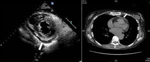 (A) Echocardiogram 2D; parasternal short-axis plane: posterior pericardial effusion (arrow). (B) Thoracic CT: evidence of sternal fracture, as well as mild pericardial effusion (arrow).
