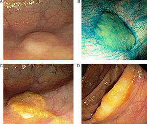 Endoscopic appearance of the serrated polyps: (A) flat polyp located in the right colon. The loss of the vascular pattern is very characteristic as the only sign of the presence of a serrated polyp; (B) the application of chromoendoscopy with indigo carmine makes it easier to determine the lesion type and its limits; (C and D) flat polyps in the right colon. The presence of a mucus plug on the surface of the polyp is a very typical characteristic of serrated polyps (original images from the archives of the Endoscopy Unit at the Hospital Clínic in Barcelona).