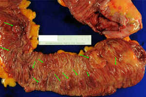 Colectomy specimen from a 59-year-old patient diagnosed with serrated polyposis syndrome during population-based CRC screening; total colectomy with ileorectal anastomosis was indicated due to polyposis that was not controllable with endoscopy. The presence of multiple flat polyps can be observed (green arrows) predominantly in the proximal colon (ileocecal valve to the right of the image). These polyps showed histology for sessile serrated adenoma, and adenocarcinomas were detected in 2 (T1N1M0 and T2N1M0) (original image by Dr. Cuatrecasas).