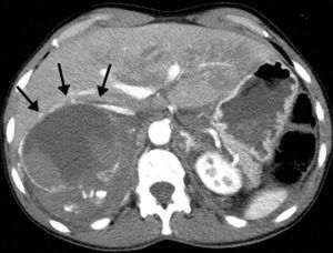 Abdominal computed tomography showing retroperitoneal hematoma with tumor rupture in the right suprarenal gland.