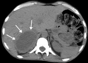 Abdominal computed tomography (4 weeks after trauma) showing partial reabsorption of the retroperitoneal hematoma with a clearer outline of the tumor.