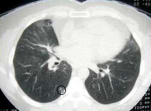 Chest CT showing a lung nodule in the right lower lobe with the hook wire located in the nodule.