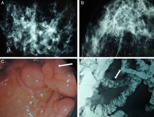 Mammography, barium transit study and digestive ultrasound images: (A) diffuse microcalcifications in the right breast; (B) diffuse microcalcifications in the left breast; (C) upper GI ultrasound reveals hamartomatous polyps in the third duodenal portion (white arrow); (D) gastrointestinal tract where filling defects are observed in the proximal jejunum that represent polypoid formations (white arrow).