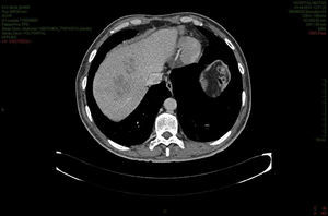 Control CT scan after 6 weeks of antibiotic treatment, progressive decrease of the liver lesions.