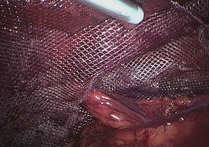 Fixation of the mesh with synthetic tissue adhesive in laparoscopic hernioplasty using an applicator.