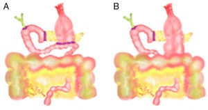 Retrocolic gastrojejunostomy (A) after antrectomy and (B) after pyloric preservation.