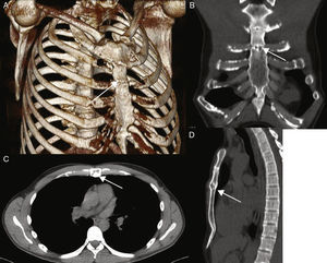 Chest CT with bone reconstruction where the arrows indicate the location of the pseudarthrosis in: (A) 3D reconstruction, (B) coronal reconstruction, (C) axial reconstruction, (D) sagittal reconstruction.
