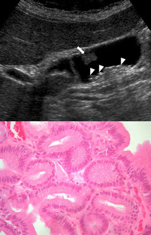 Tubular adenoma tubular (bold arrow); cholelithiasis in sloping area (arrowheads) confirmed by histology (hematoxylin–eosin preparation 40×).