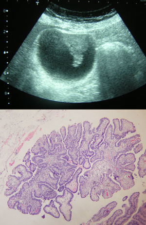 Ultrasound image of a papillary adenocarcinoma, with its corresponding histology (hematoxylin–eosin 10×).