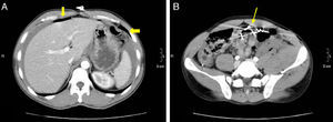 37-Year-old male with perforation of the small intestine by birdshot pellets: (A) MDCT with IV contrast showing an axial slice of the upper abdomen with pneumoperitoneum (bold arrow); (B) axial slice of the same patient with multiple intraabdominal birdshot pellets (arrow). The perforation of the small intestine was identified during surgery.