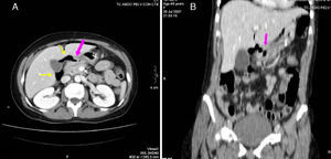 46-Year-old woman with pneumoperitoneum due to a perforated ulcer: (A) on MDCT with IV contrast, an important perihepatic and periportal pneumoperitoneum is identified (thin arrows), suggesting upper gastrointestinal perforation; (B) coronal reconstruction was able to confirm the defect in the anterior wall of the gastric antrum (bold arrow), which was also observed in axial slice A. Surgery confirmed the presence of a perforation in the gastric antrum.
