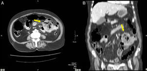 82-Year-old woman with pneumoperitoneum: (A) MDCT axial slice with IV contrast showing multiple extraluminal gas bubbles and a 7cm collection (arrow) with irregular wall, adjacent to the jejunum; (B) coronal reconstruction demonstrating an abscess (arrow) and jejunum. The pathology report confirmed perforated GIST of the small intestine.